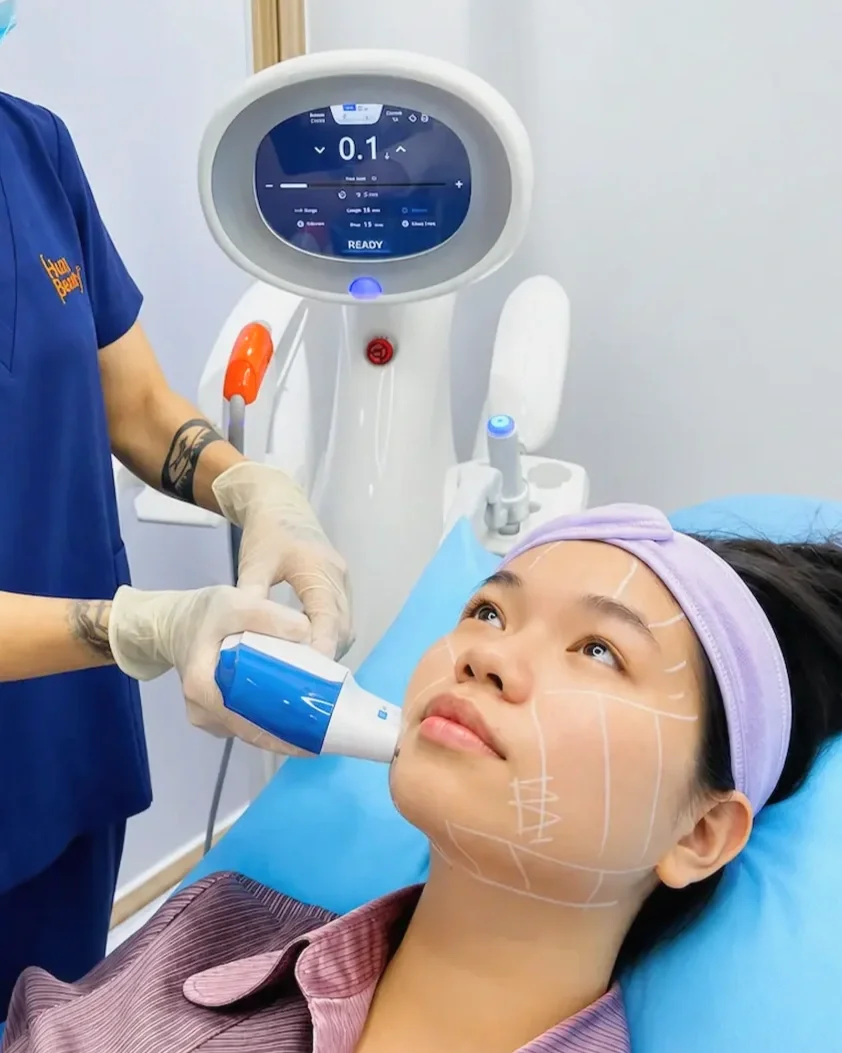 Ultraformer MPT HIFU facial lifting and skin tightening treatment in Ho Chi Minh City