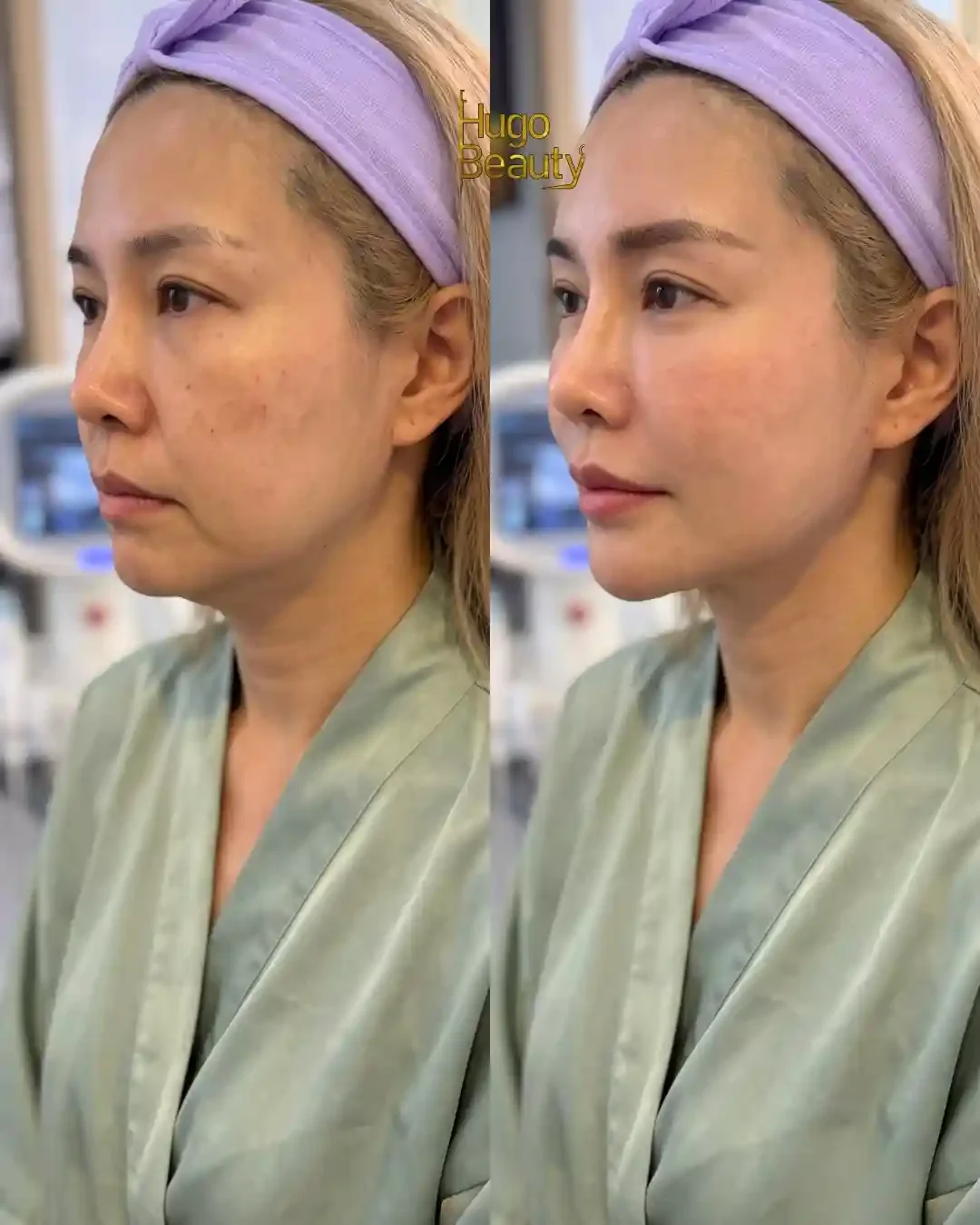So sánh khuôn mặt ở góc nghiêng trước và sau khi thực hiện HIFU tại Hugo Beauty, TP.HCM.