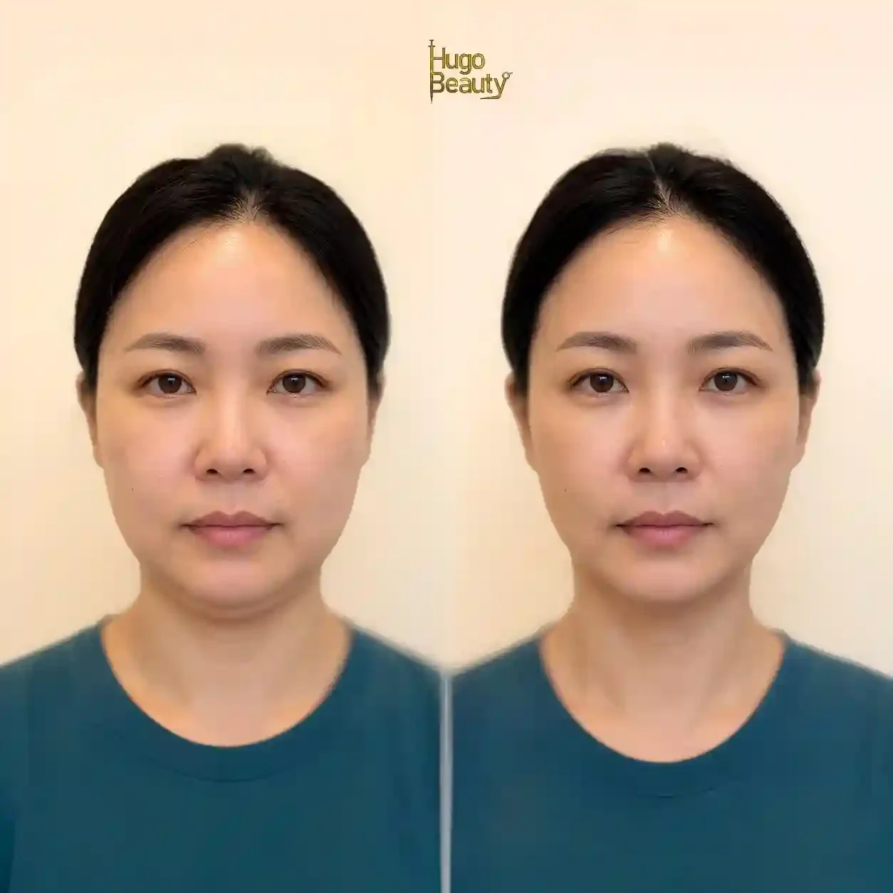 Ảnh chính diện trước và sau HIFU của khách nữ áo xanh, chụp cùng góc tại Hugo Beauty TP.HCM