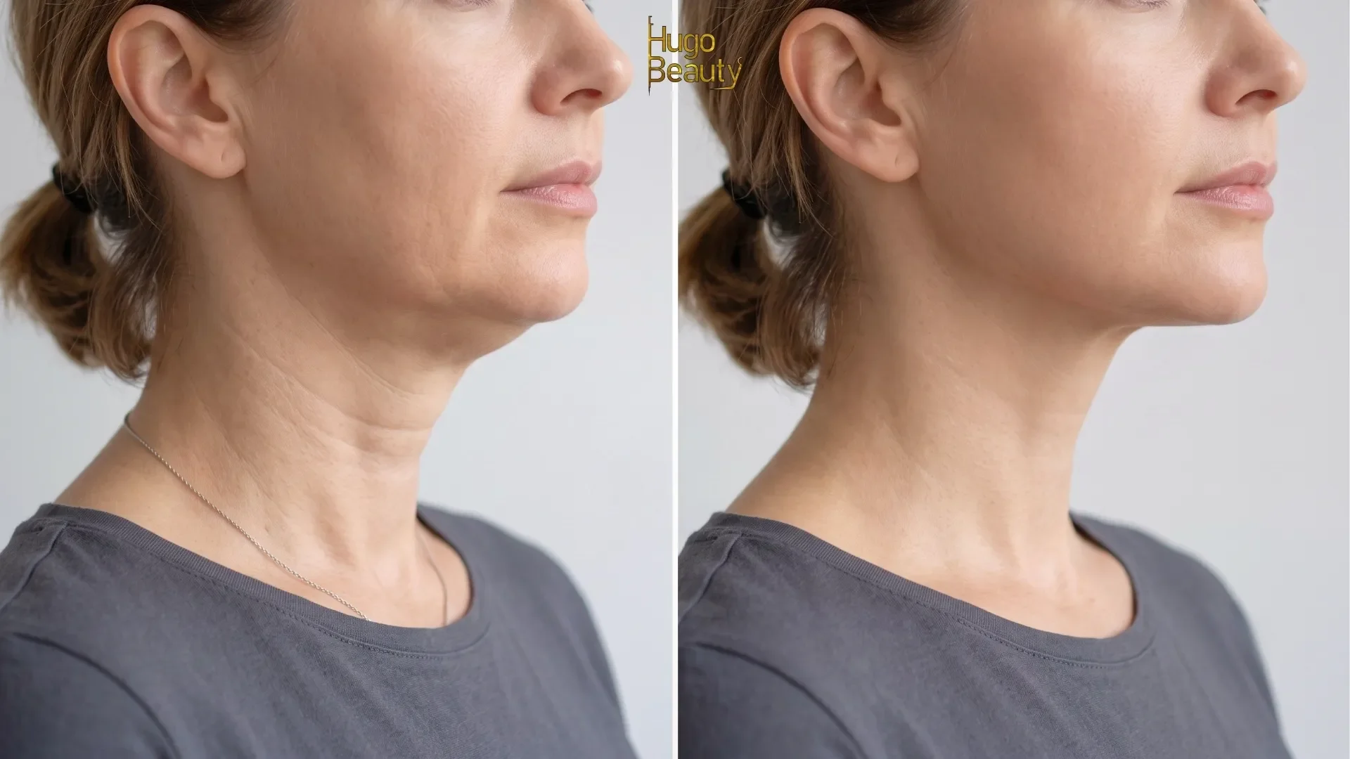 HIFU nâng cơ và săn chắc vùng cổ bằng công nghệ Ultraformer MPT tại Hugo Beauty TP.HCM