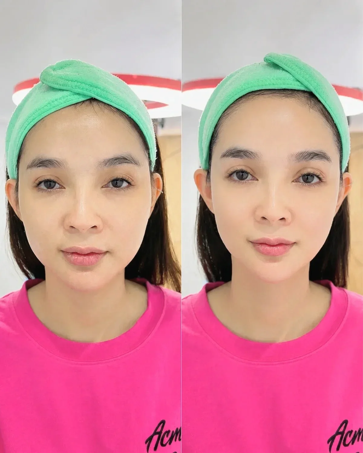 Hình ảnh trước và sau nâng cơ HIFU tại Hugo Beauty giúp gương mặt săn chắc và trẻ trung tự nhiên