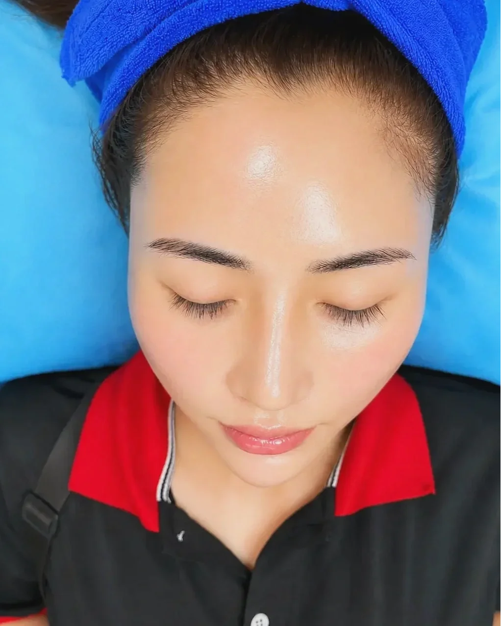 filler, botox, skin booster – kỹ thuật trẻ hóa da với Hyaluronic Acid tinh khiết, giúp da căng bóng và săn chắc tự nhiên.