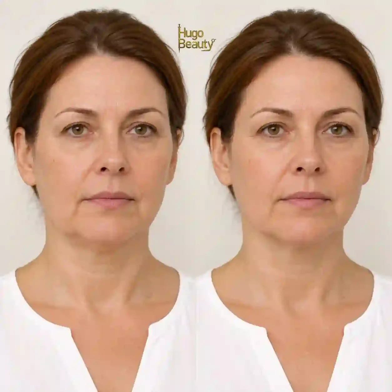 lower-face-hifu-before-after-front-view-hugo-beauty-hcmc