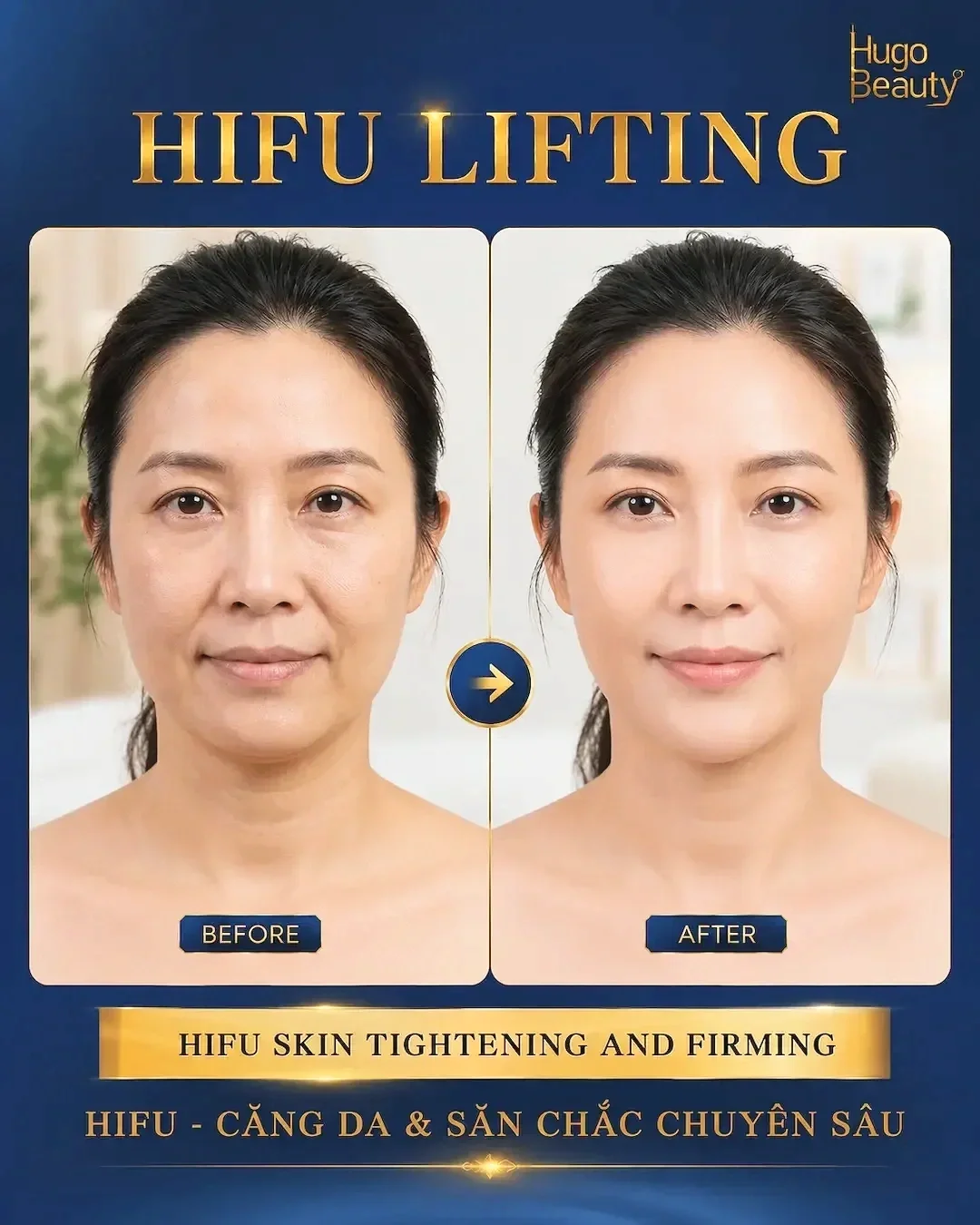 Before and after appearance following HIFU skin tightening treatment at Hugo Beauty in Ho Chi Minh City.