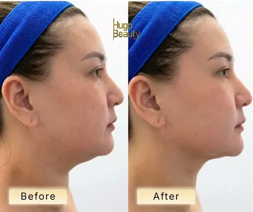 Before and after double chin reduction with HIFU at Hugo Beauty