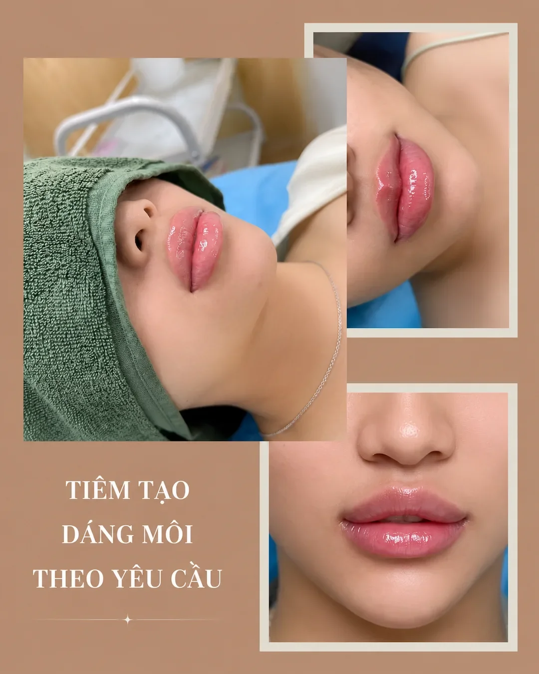 Môi glossy tự nhiên sau tiêm tạo dáng môi theo yêu cầu tại Hugo Beauty TP.HCM, dáng môi căng bóng hài hòa gương mặt
