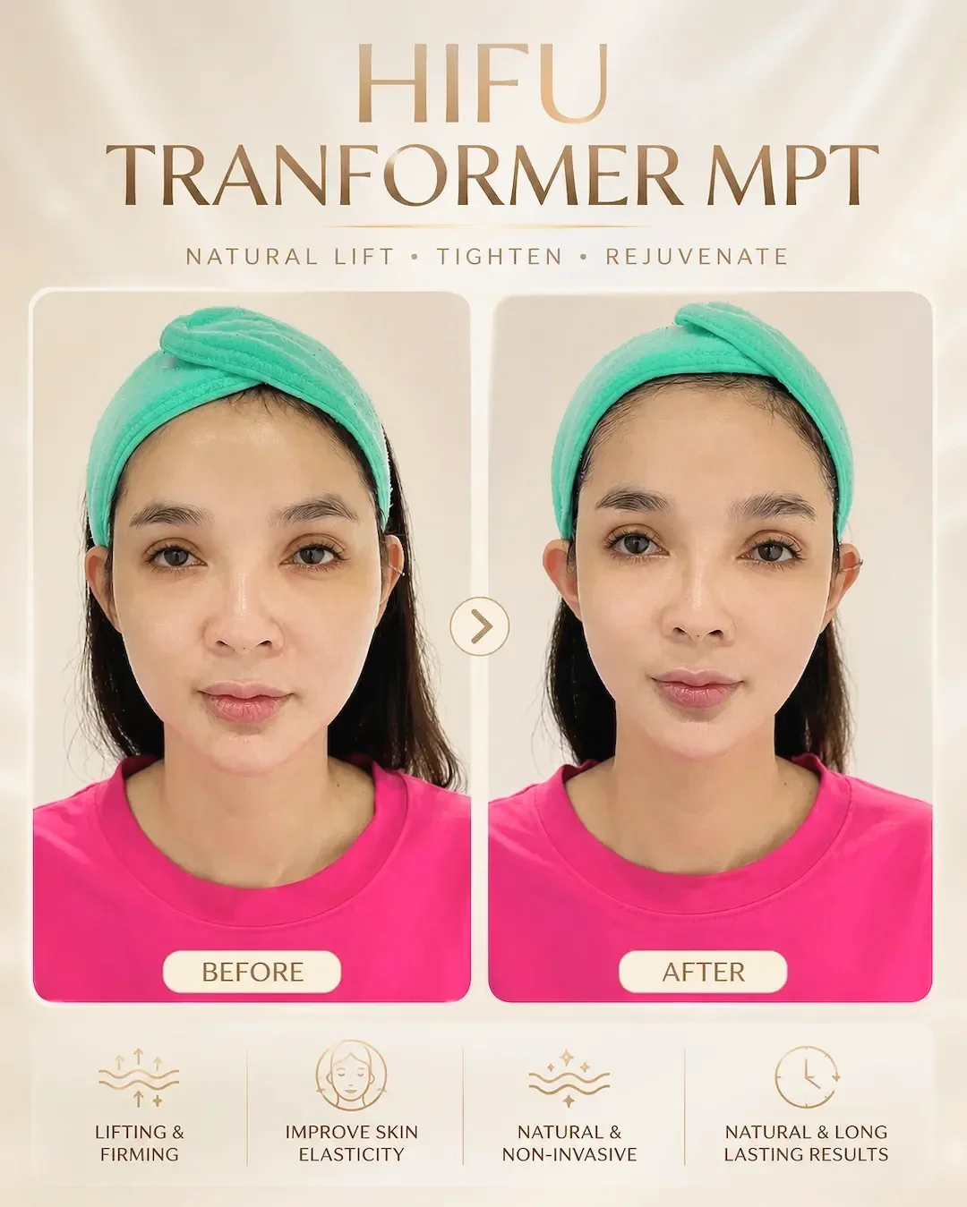 HIFU before and after jawline and cheek contouring at Hugo Beauty in Phu Nhuan, Ho Chi Minh City