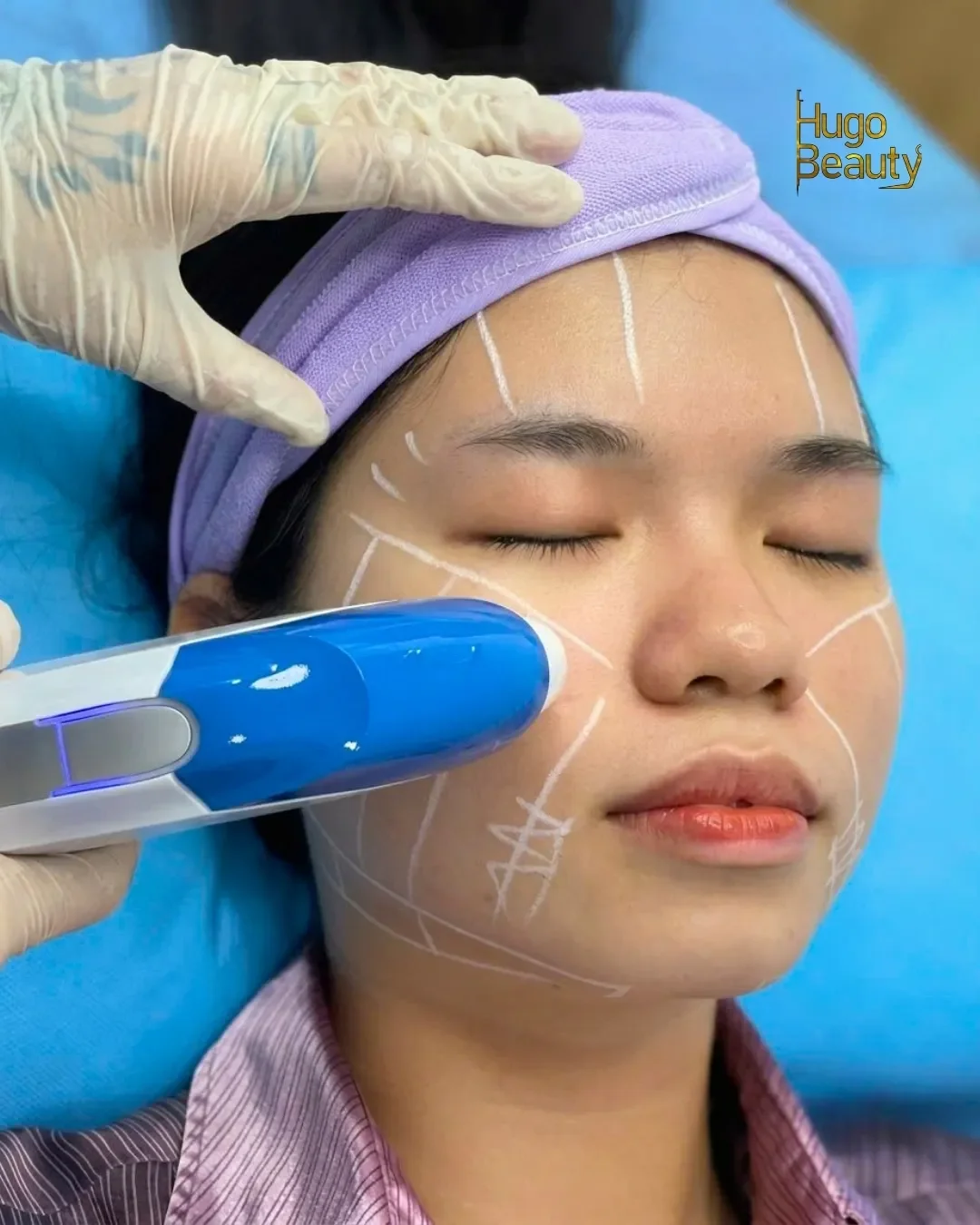 Nâng cơ HIFU tại Hugo Beauty Phú Nhuận, TP.HCM