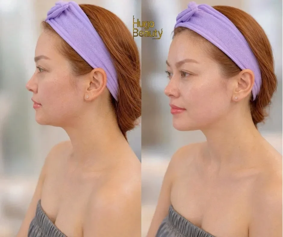 Hình ảnh trước và sau khi làm HIFU nâng cơ tạo đường viền hàm tại Hugo Beauty TP.HCM