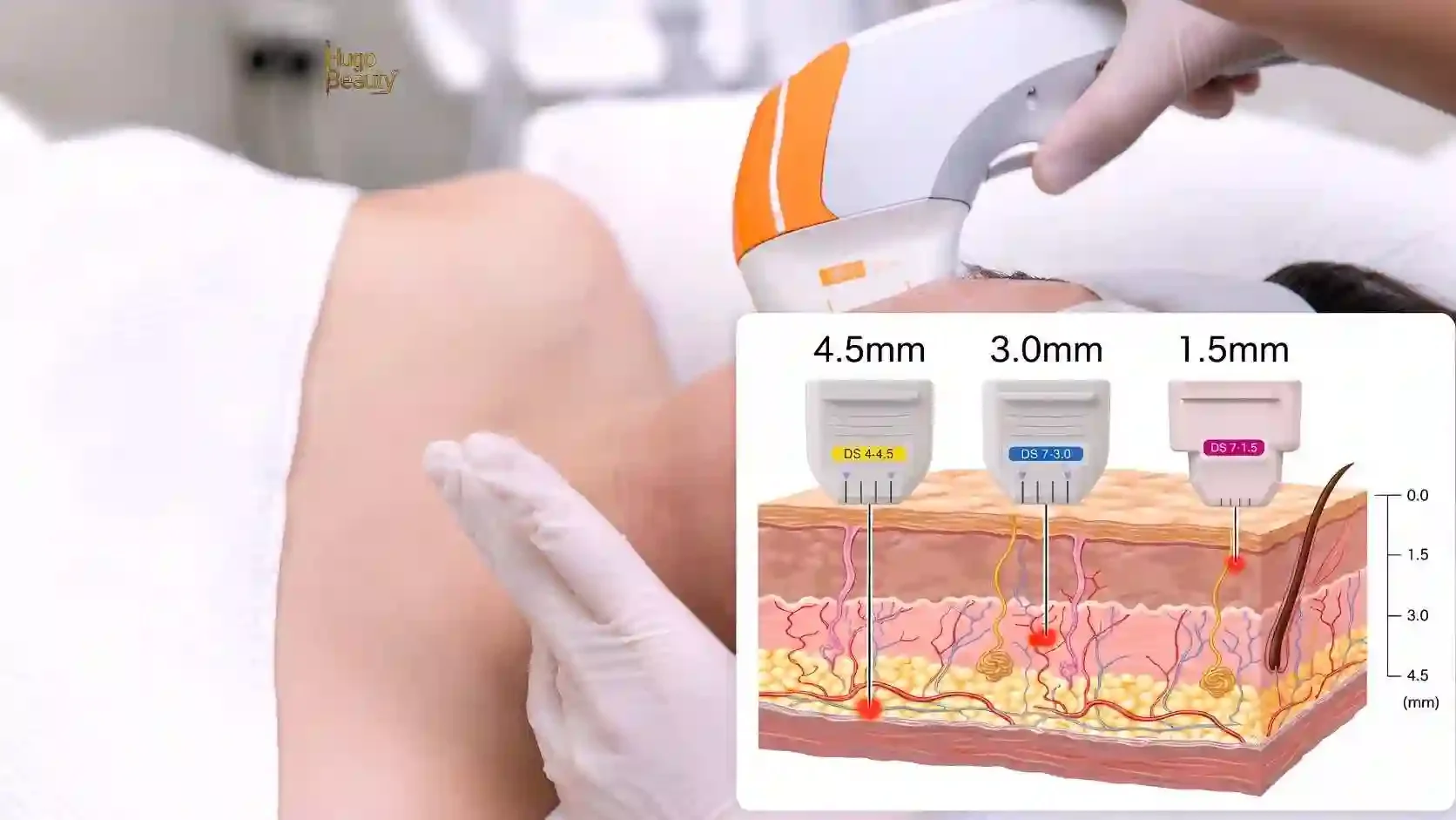 Sơ đồ minh họa đầu tip HIFU 4,5 mm và 3,0 mm đưa năng lượng xuống các lớp da khác nhau, kèm ảnh buổi làm thực tế