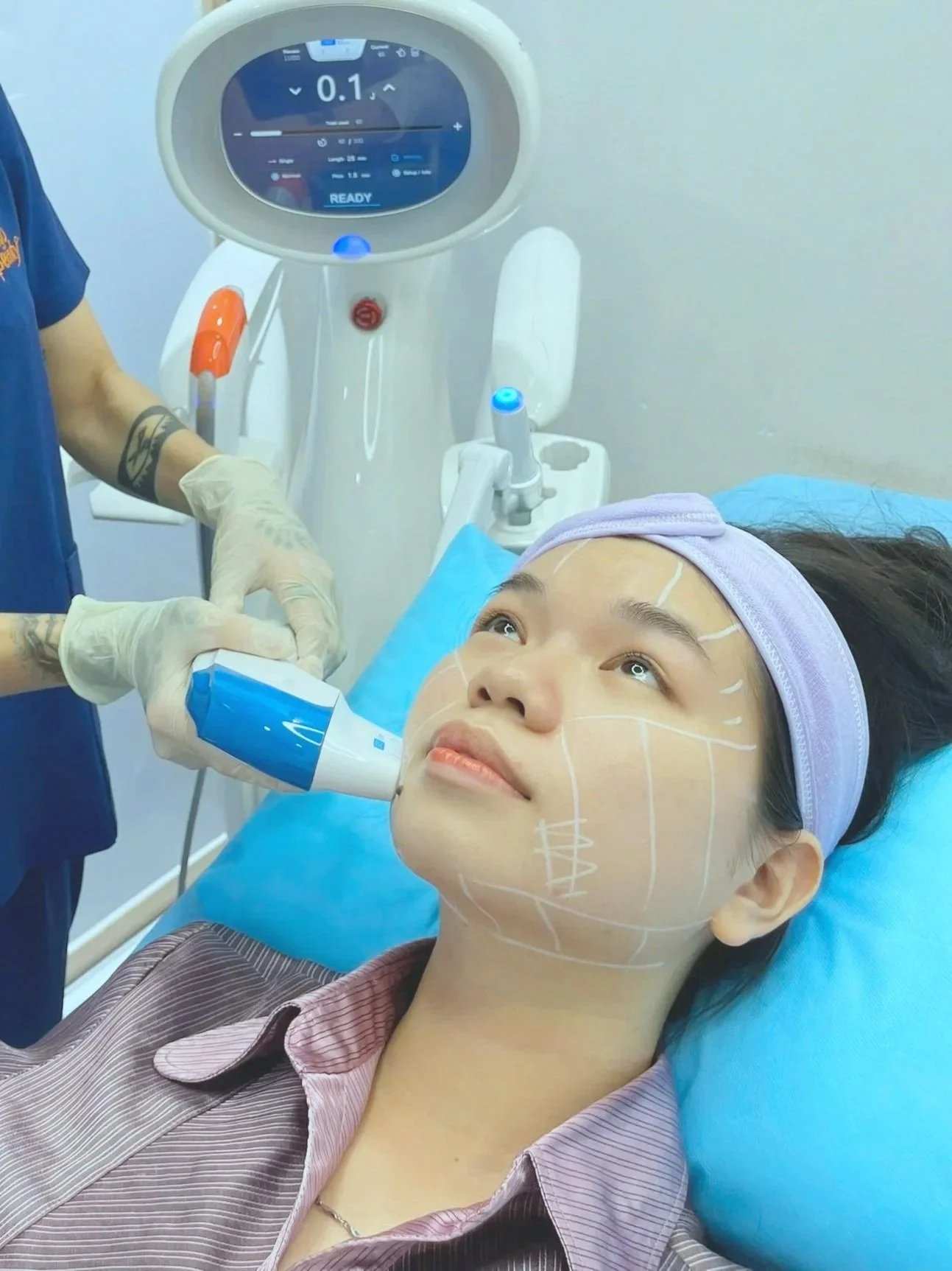 A woman lying on a medical bed receiving facial treatment with a handheld device while a medical professional uses a similar device nearby. The woman's face has white lines drawn on it, likely for cosmetic purposes, and she is wearing a headband.