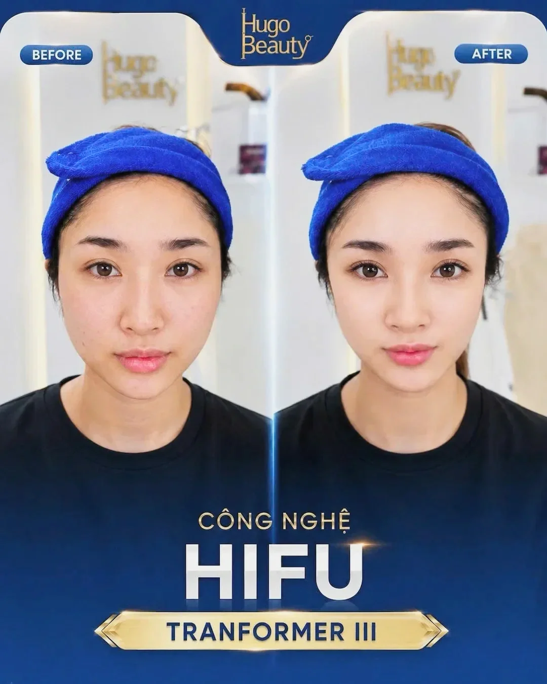 HIFU facial lifting and skin tightening at Hugo Beauty in Phu Nhuan District Ho Chi Minh City using HIFU Transformer III