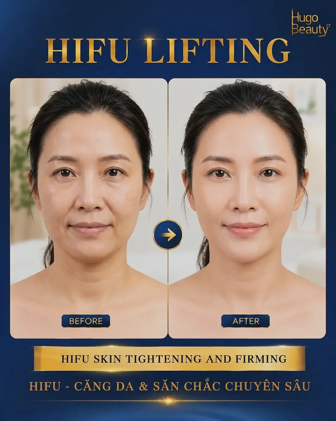 Before and after HIFU skin lifting treatment at Hugo Beauty showing firmer, smoother, and naturally lifted skin