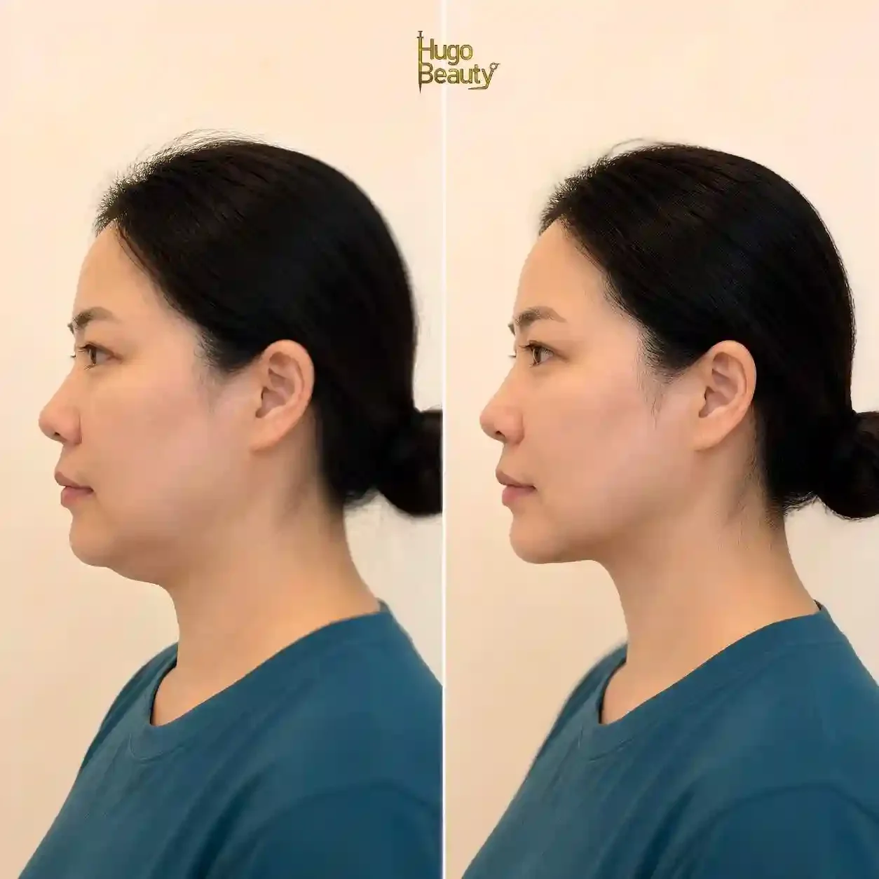 Khách hàng trước và sau liệu trình HIFU Ultraformer MPT tạo đường viền hàm tại Hugo Beauty TP.HCM