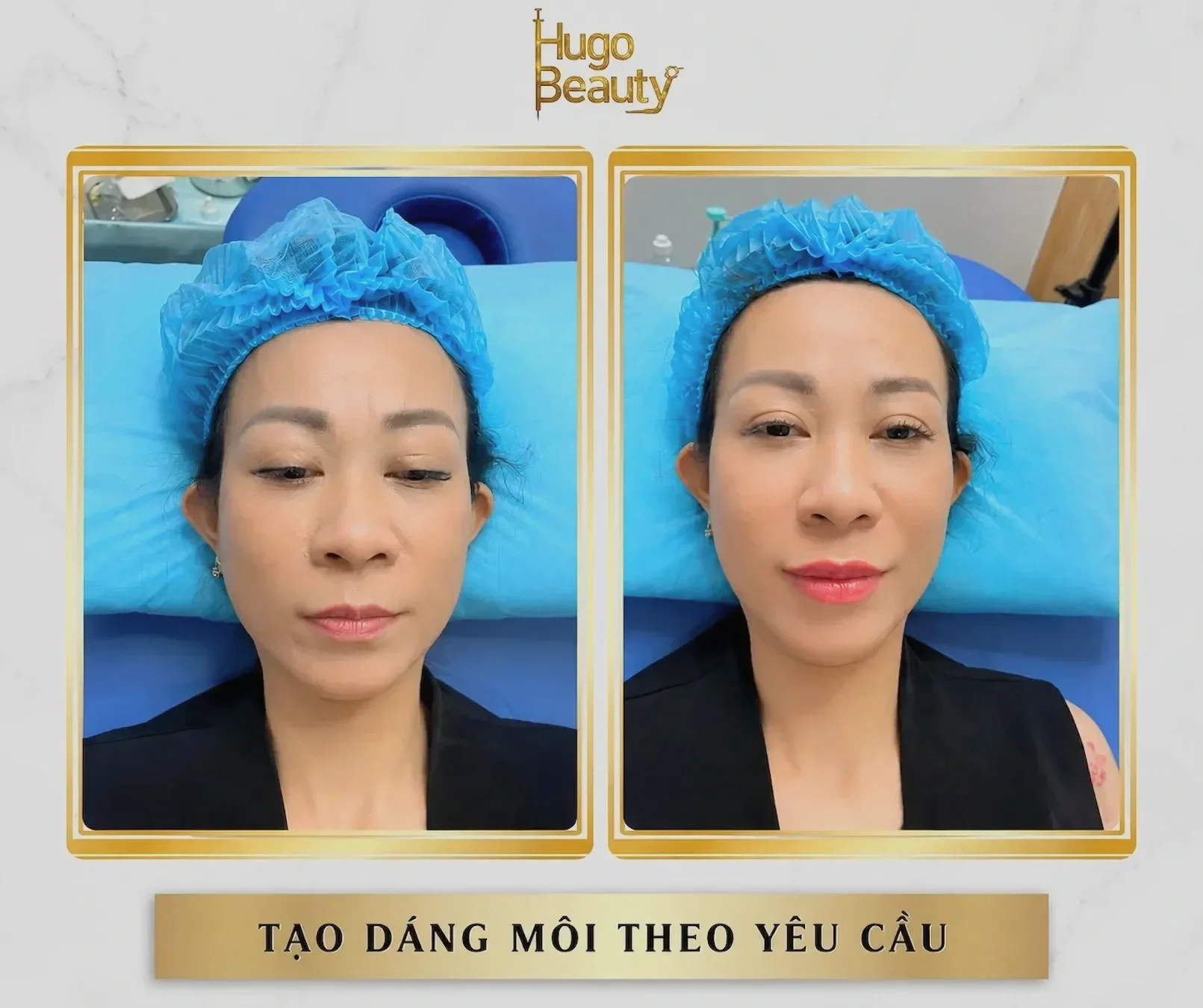 Tạo dáng môi theo yêu cầu tại Hugo Beauty với hình ảnh trước và sau, dáng môi tự nhiên hài hòa và gương mặt tươi tắn hơn