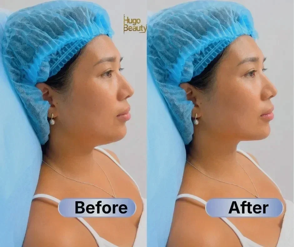 Before and after Ultraformer MPT jawline contouring at Hugo Beauty