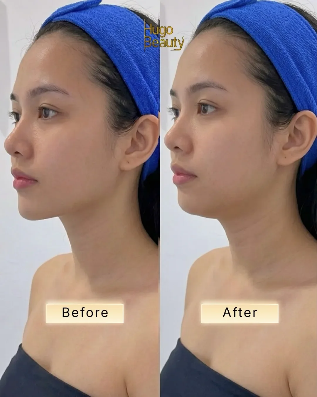 Nâng cơ và làm sắc nét đường viền hàm bằng HIFU tại Hugo Beauty TP.HCM