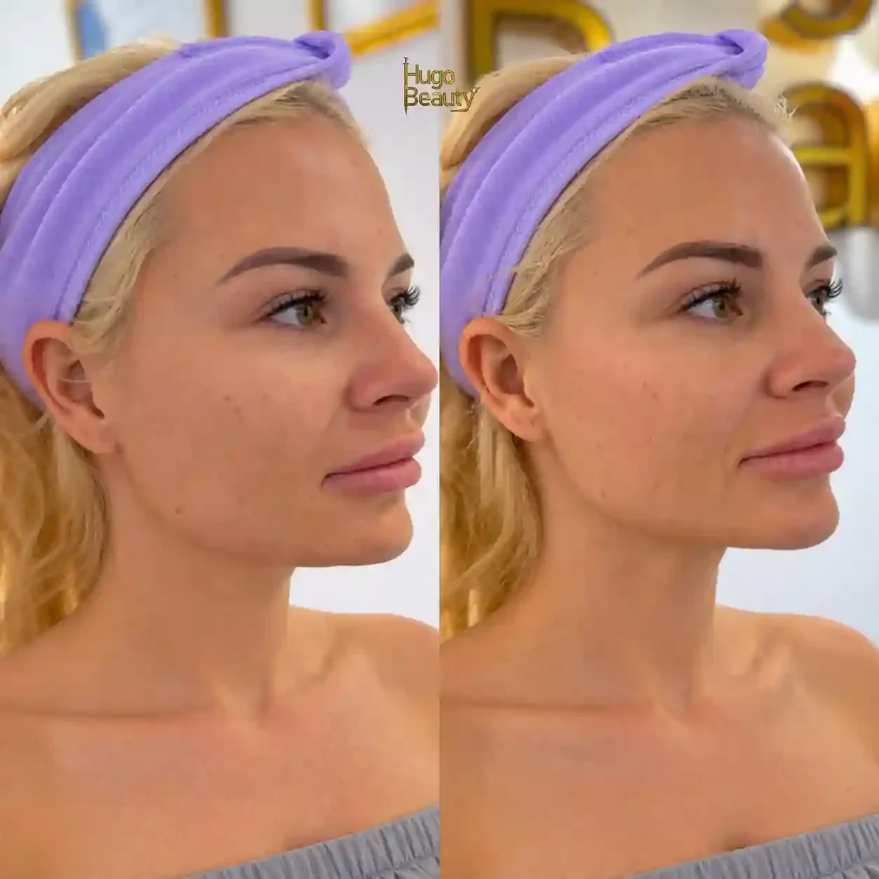 Ảnh trước và sau HIFU góc nghiêng 3/4 của khách Hugo Beauty, chụp cùng ánh sáng và cùng góc