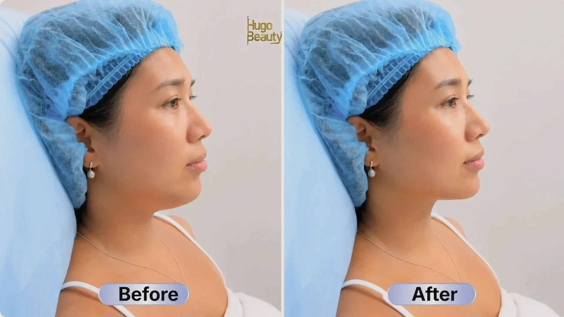 Before and after Ultraformer MPT HIFU jawline lift at Hugo Beauty HCMC