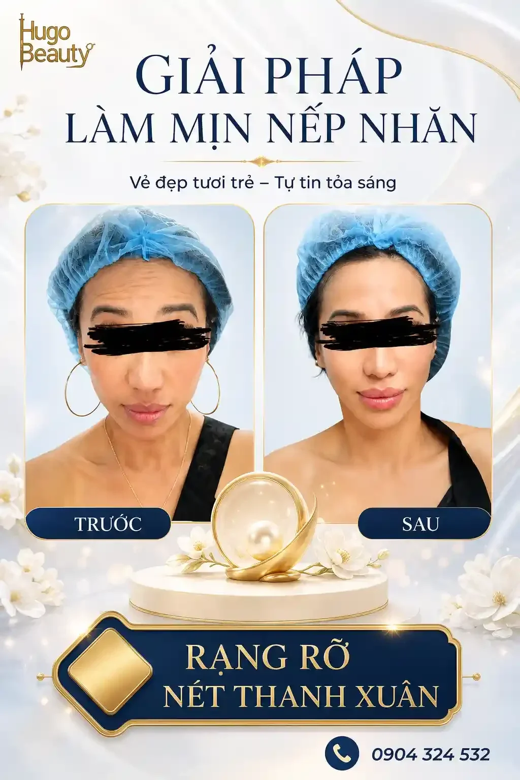Softer forehead lines and a rested, natural expression after facial balance care at Hugo Beauty in Ho Chi Minh City