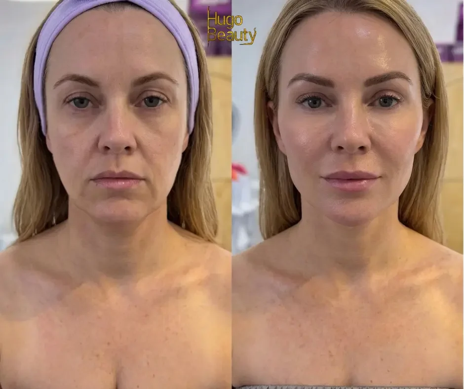 Hình ảnh trước và sau khi nâng cơ HIFU Ultraformer MPT giúp săn chắc da mặt tại Hugo Beauty Phú Nhuận