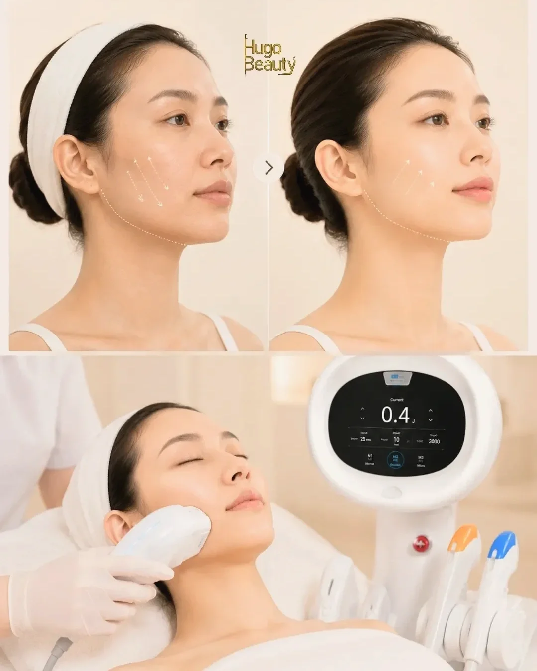 Dịch vụ nâng cơ trẻ hóa da HIFU uy tín tại Hugo Beauty Phú Nhuận, TP.HCM.