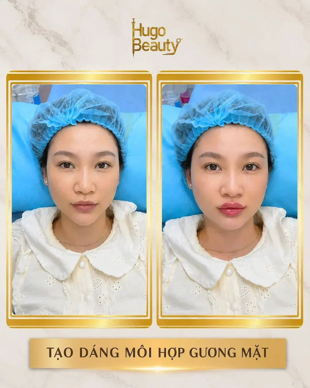 Hình ảnh trước và sau tạo dáng môi hài hòa với gương mặt tại Hugo Beauty Phú Nhuận.