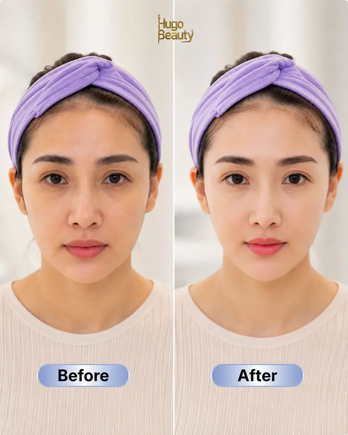 Before and after photos of lower face lifting and jawline contouring with Ultraformer MPT HIFU at Hugo Beauty in Ho Chi Minh City.