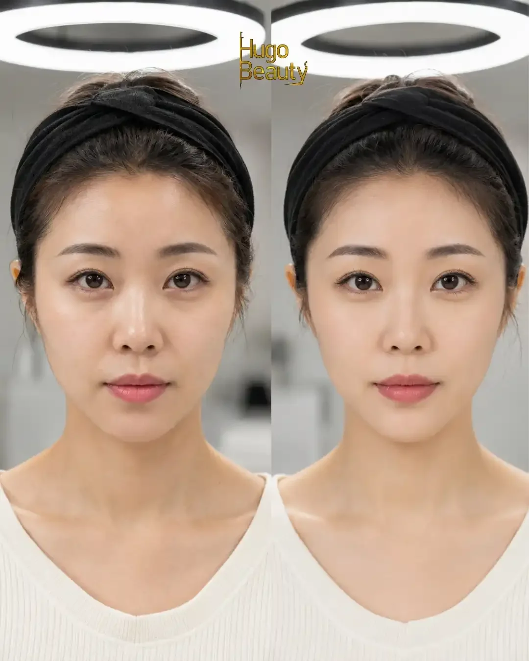 So sánh chính diện trước và sau HIFU vùng viền hàm của khách nữ tại Hugo Beauty TP.HCM