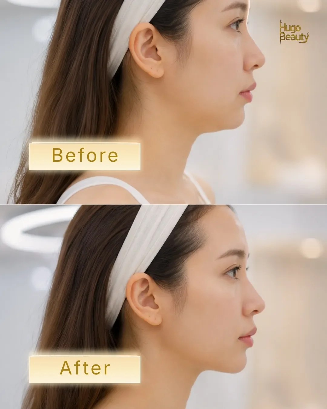 Hình ảnh góc nghiêng trước và sau khi thực hiện HIFU Ultraformer MPT tại Hugo Beauty.