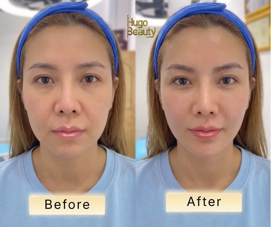 Hình ảnh đối chiếu hai góc mặt trong liệu trình nâng cơ trẻ hóa da HIFU tại Hugo Beauty Tp. HCM