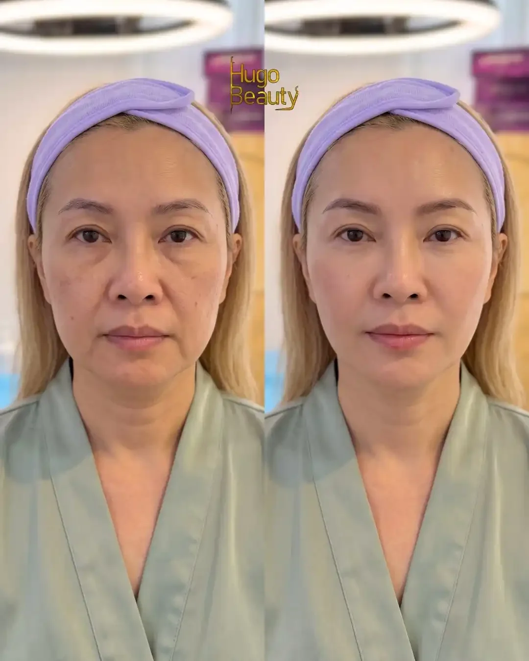 So sánh khuôn mặt trước và sau khi thực hiện HIFU tại Hugo Beauty