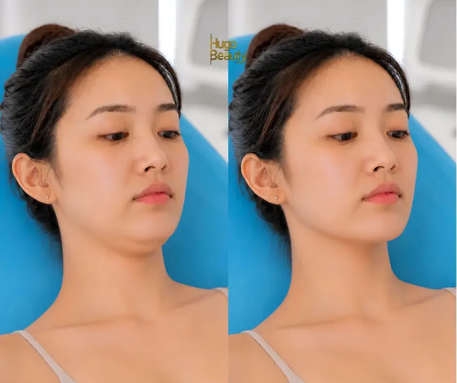 Hình ảnh trước và sau khi thực hiện HIFU cải thiện nọng cằm ở người gầy
