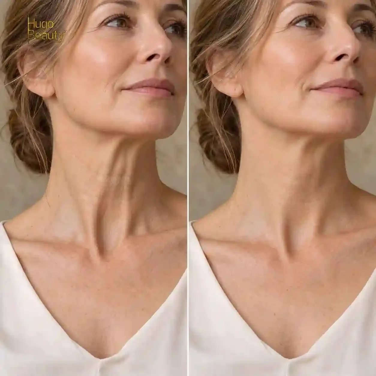 Hai ảnh nghiêng vùng cổ của khách nữ lớn tuổi chụp cùng góc tại Hugo Beauty — da cổ có nếp mảnh, còn đàn hồi là mức HIFU còn có việc; nếp gấp da rõ thì nên tham khảo bác sĩ phẫu thuật
