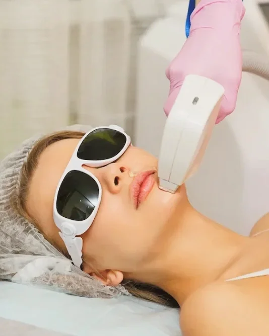 Triệt lông lạnh Diode Laser vùng mặt tại Hugo Beauty Phú Nhuận TP HCM