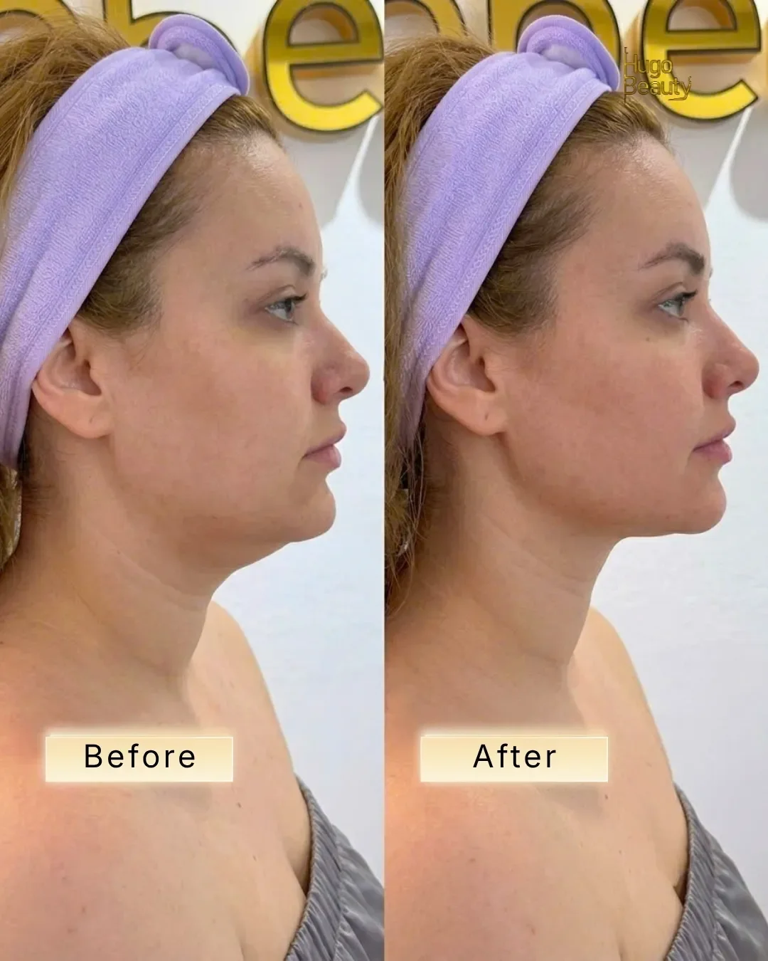 Hình ảnh trước và sau khi nâng cơ mặt bằng công nghệ HIFU Ultraformer MPT tại Hugo Beauty TP.HCM