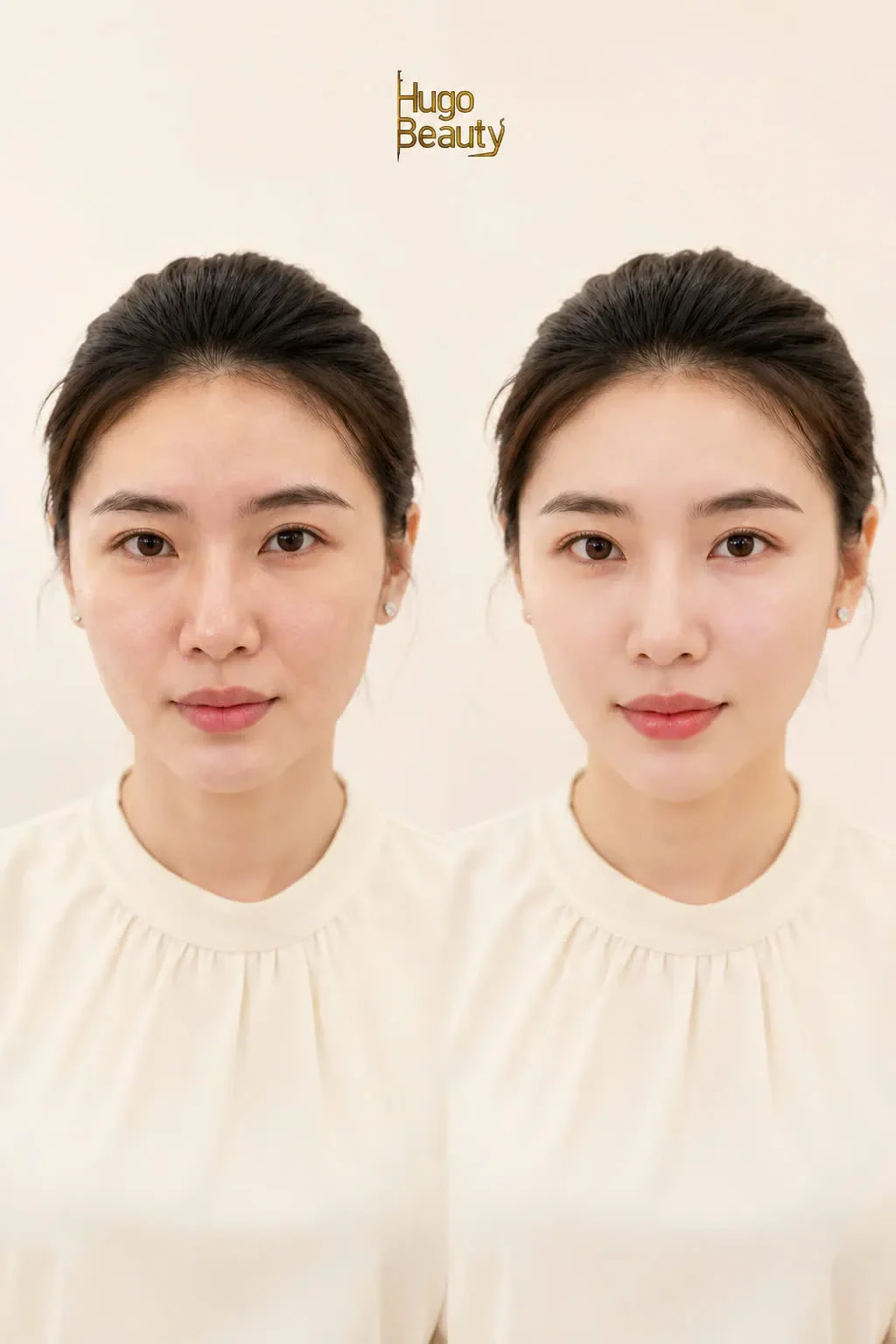 Before and after HIFU lower face lifting results at Hugo Beauty in Ho Chi Minh City, Vietnam.
