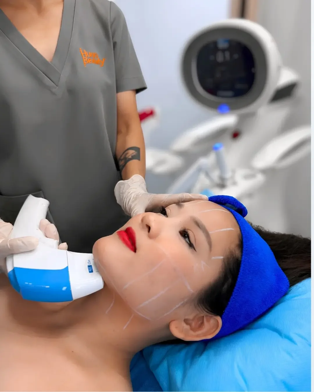 Khách hàng thực hiện HIFU vùng nọng cằm bằng Ultraformer MPT tại Hugo Beauty TP.HCM