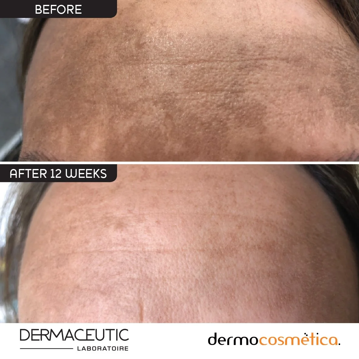 Dermaceutic Mela Cream Before After Image.jpg