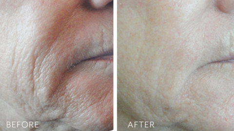 Retriderm 1.0 _RETRIDERM_JOAN_CHEEK_B_A_480x480.png
