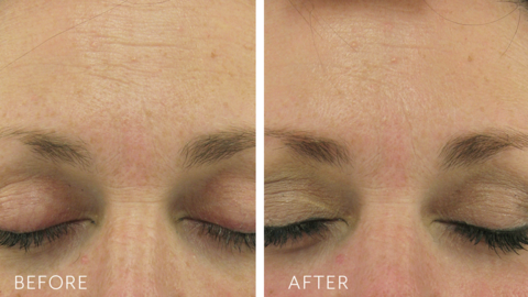Retriderm 0.5 _RETRIDERM_FOREHEAD_B_A_480x480.png