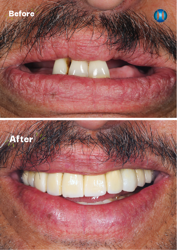Close-up of a man's mouth showing significant dental improvement after dental work. The top image shows missing and yellowed teeth, while the bottom image shows a full, even, white smile.