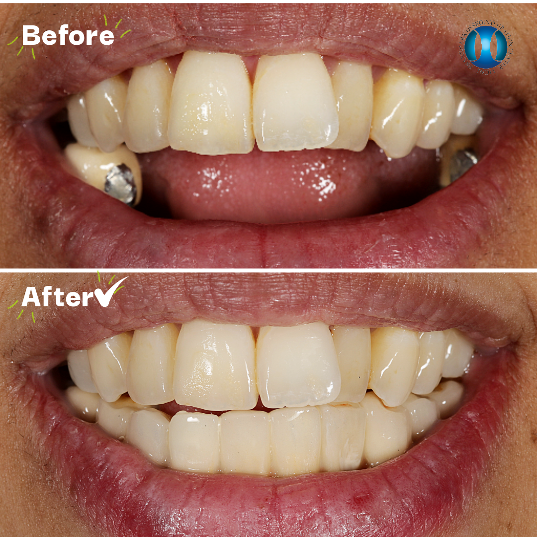 Close-up of a person's teeth showing a before and after comparison of dental restoration. The before image shows discolored, chipped, and uneven teeth with dental crowns on molars. The after image displays whiter, even teeth with improved alignment and appearance.