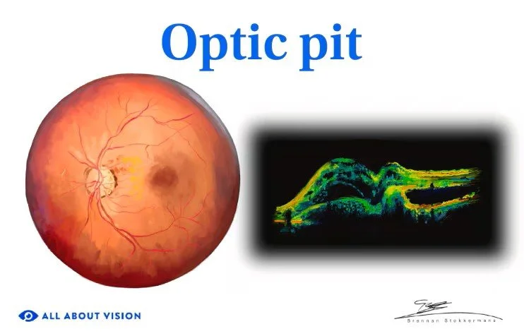 Optic pit (Jul 22, 2025) 