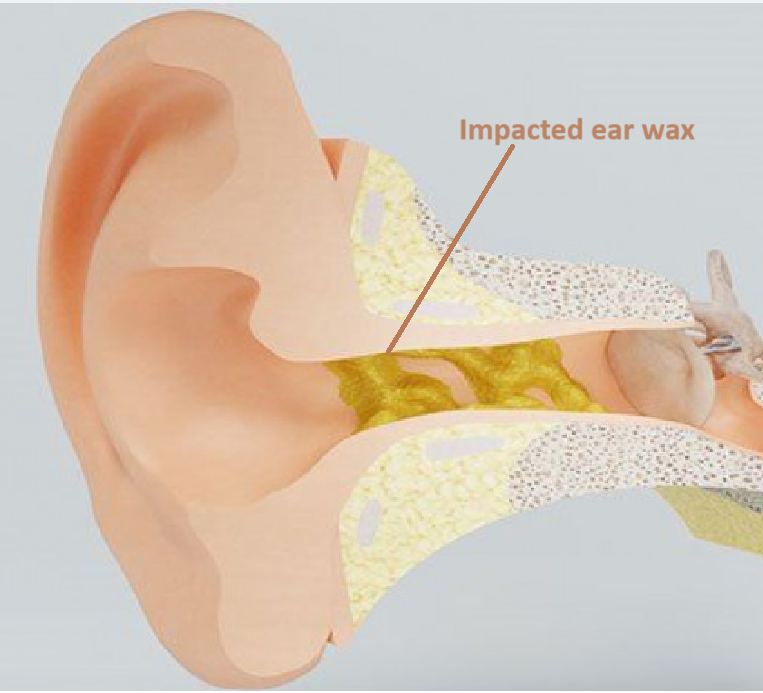 Crust Build Up In Ear Norfolk Ear Wax Removal
