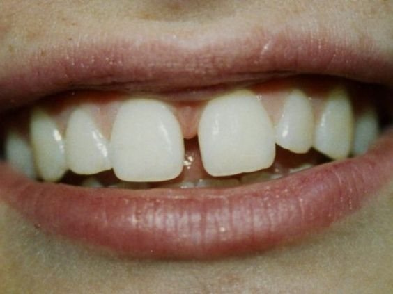 gap tooth.jpeg