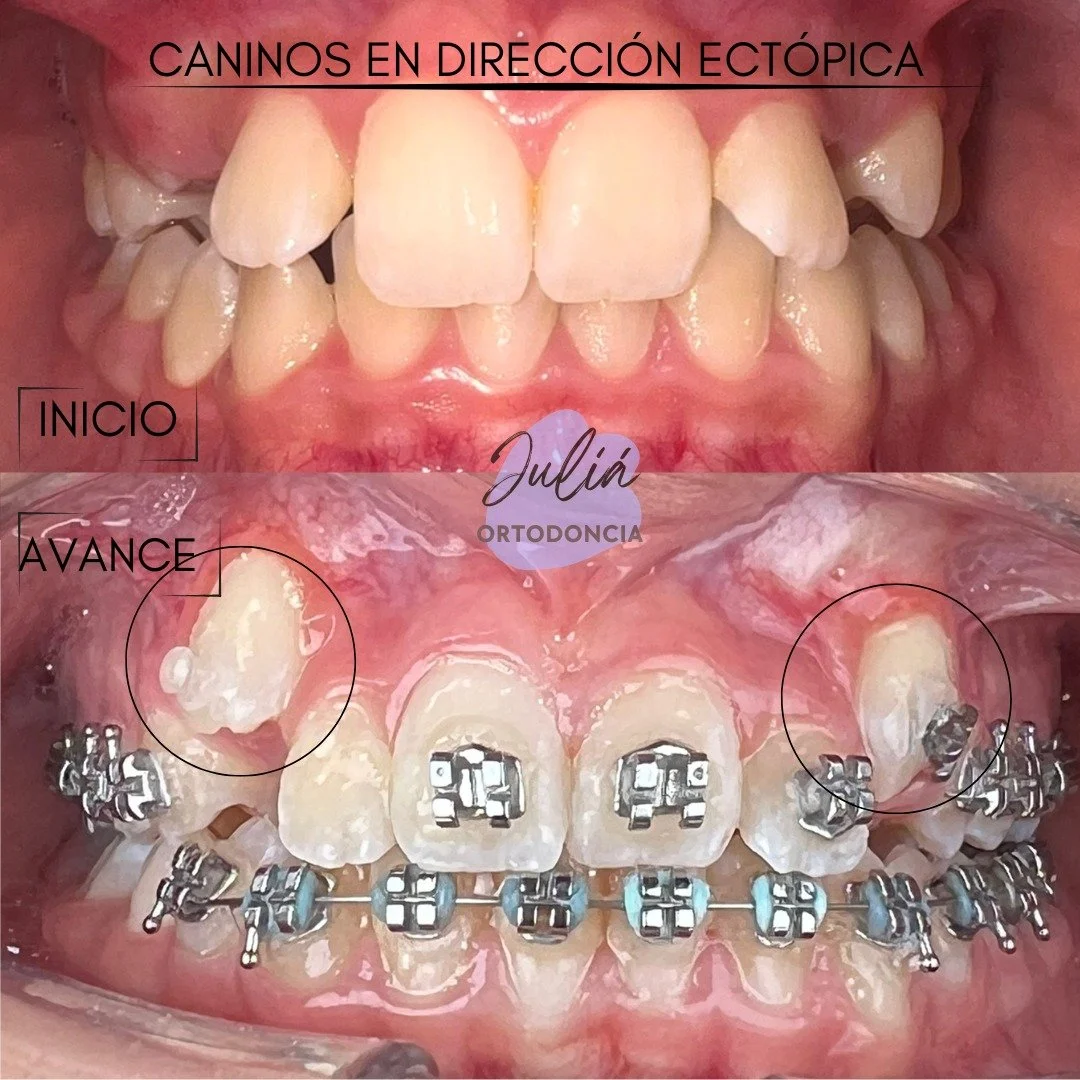 La importancia de actuar a tiempo cuando se nos presentan estos casos para evitar destrucciones en los dientes vecinos. 

#Ortodoncia ##diagn&oacute;sticoenortopedia #ortodoncialaserena #odontologialaserena