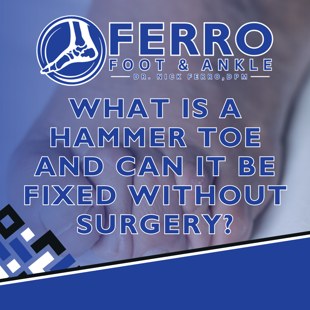 What Is a Hammer Toe and Can It Be Fixed Without Surgery?