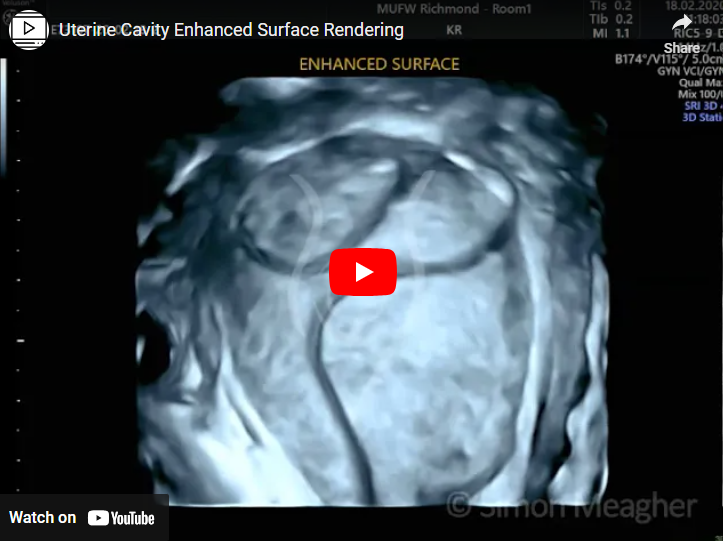 Uterine Cavity Enhanced Surface Rendering