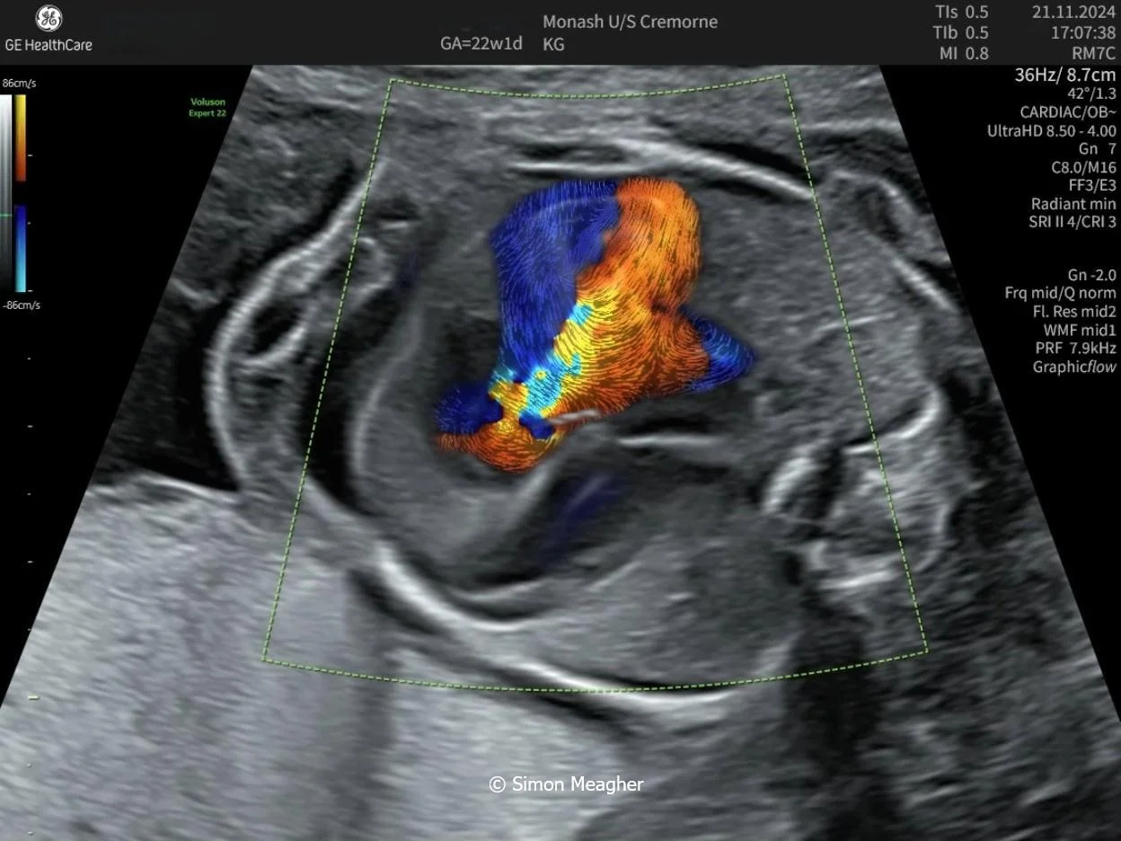 Fetal Cardiac Meeting